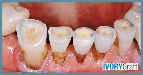 Dentin - Exposure and Tooth Wear - mr