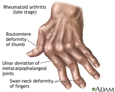 Rheumatoid arthritis: MedlinePlus Medical Encyclopedia