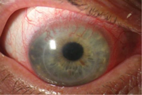Eye Disorders :: Eye Health Central