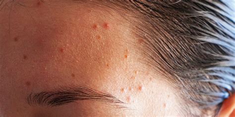 Forehead Acne: The causes and best treatments according to derms