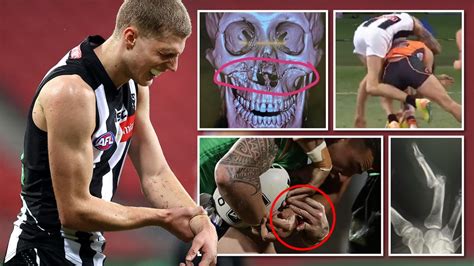 The worst AFL and NRL injuries in 2020 | Gold Coast Bulletin