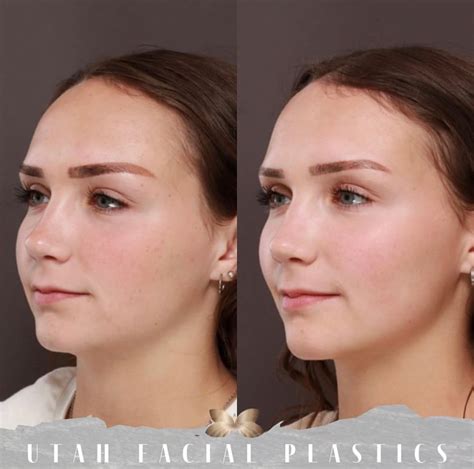 What is Forehead Reduction Surgery? - Utah Facial Plastics