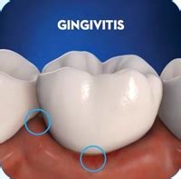 Bleeding Gums And Gingivitis | Hastings Family Dental