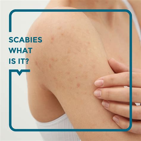 Scabies: symptoms, treatments, and prevention - Alegria Medical Centre