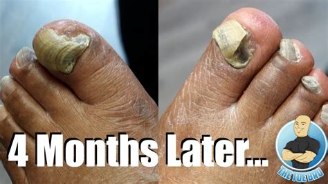 How To Get Rid Of Thick Toenails - All You Need Infos