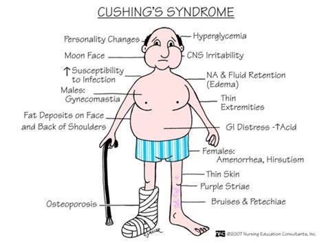 Cushing's Syndrome: Signs and Symptoms