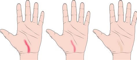 5 Ways to Heal a Scar | The Hand Society