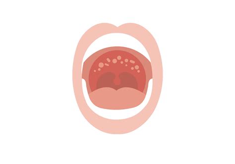 Why Do I Have Red Dots At The Top Of My Mouth Meaning - Infoupdate.org