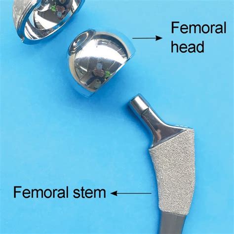 1 Metal on polyethylene total hip replacement. | Download Scientific ...