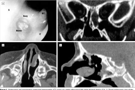 Choanal Atresia | Semantic Scholar