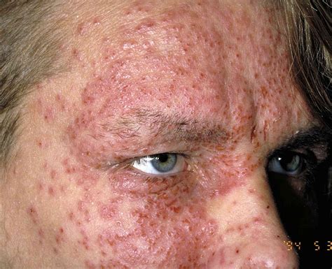 Eczema Patches On Face | My XXX Hot Girl