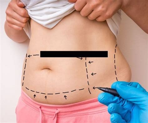 Best Liposuction Clinics in Seoul│Lydian Liposuction Clinic, Seojin, THE PLUS, 365mc and more