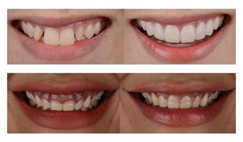 Transform Your Teeth with Clear Aligners: Before and After Pictures