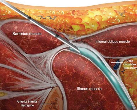 Ultrasound-guided supra-inguinal fascia iliaca block: a cadaveric evaluation of a novel approach ...