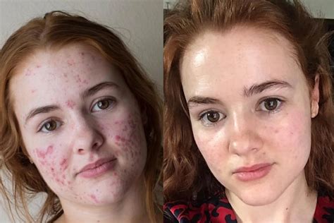 Accutane Before And After Results: Is The Process Safe?