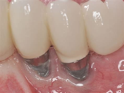 Dental Implant Complications - Dentistry Today