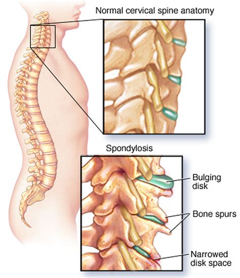 Upper Back Pain - Middle, Shoulder Pain Causes & Treatment