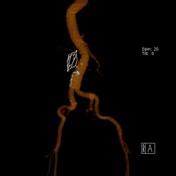 Inferior vena cava filter | Radiology Reference Article | Radiopaedia.org