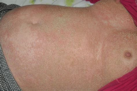 Treatment of Generalized Pustular Psoriasis of Pregnancy With ...