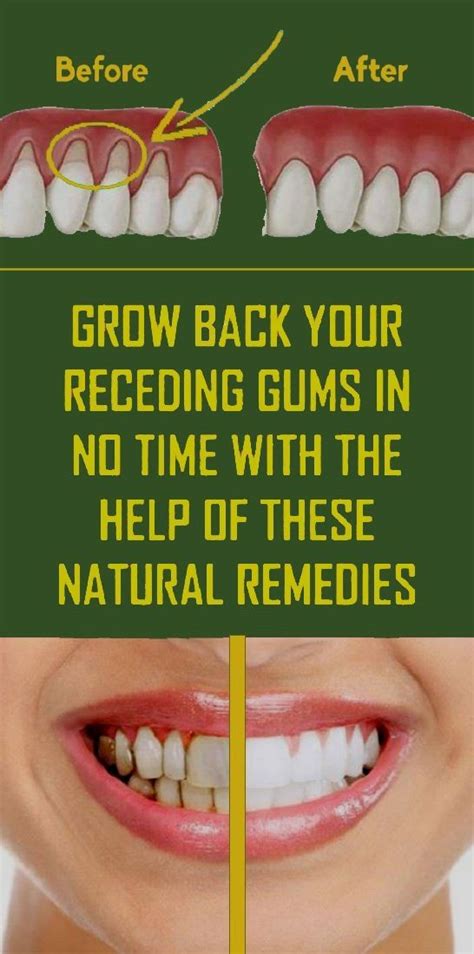 Pin by pasha.kuybedin on Health in 2020 | Receding gums, Natural ...