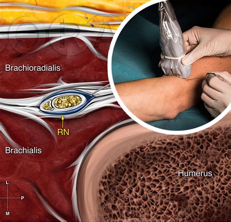 Ultrasound-Guided Blocks at the Elbow - NYSORA