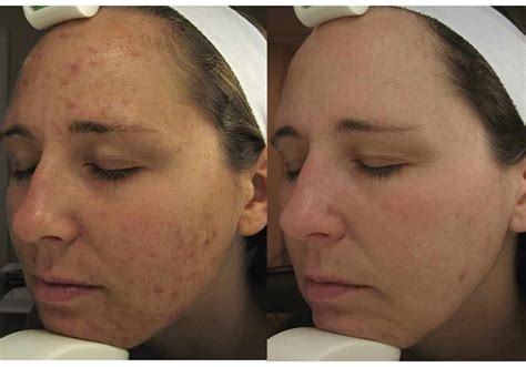 Smoothbeam Laser Treatment For Sebaceous Hyperplasia - The Best Picture Of Beam