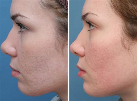 Best Acne Scar Treatements Revealed With Comparisons – Best Infrared red light, led light ...