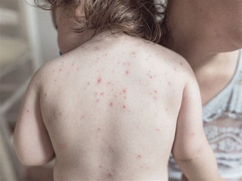 Red dots on skin: Pictures, causes, treatment, and when to seek help ...