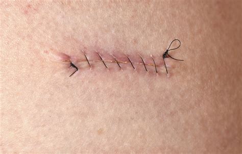 Is Wider Suture Spacing Associated With Better Postsurgical Outcomes ...