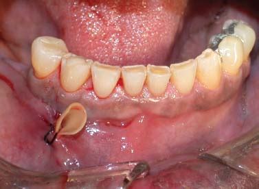 Incision And Drainage Abscess Tooth - Best Drain Photos Primagem.Org