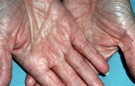 Ichthyosis Vulgaris - Causes, Symptoms, Complications & Treatment