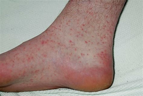 Rat bite fever causes, symptoms, rash, diagnosis & treatment