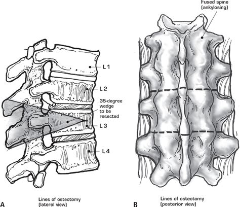 Pedicle Subtraction Osteotomy/Smith Peterson Osteotomy | Neupsy Key