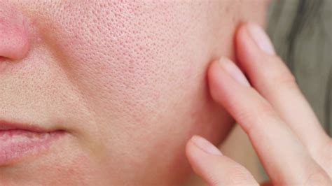 Light Therapy for Rosacea: Everything You Need To Know