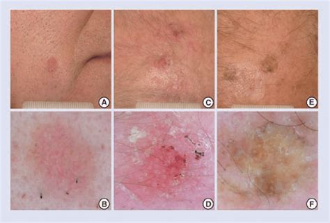 Morphologic Grading And Treatment Of Facial Actinic Keratosis Clinics | My XXX Hot Girl