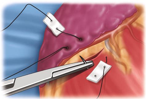 Penetrating Trauma | Basicmedical Key