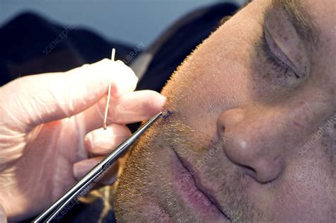 Removing stitches from the face - Stock Image - C002/8787 - Science ...