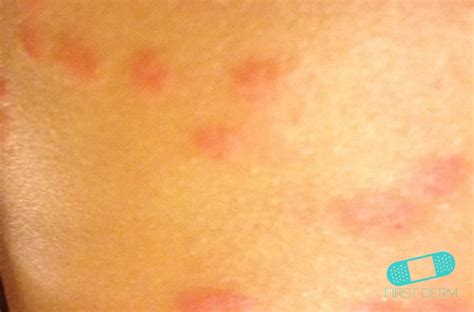 10 Common Skin Rashes In Children Hergamutcom Images - vrogue.co