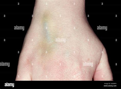 Thrombosed vein after cannulation. Close-up of the hand of a 36-year ...