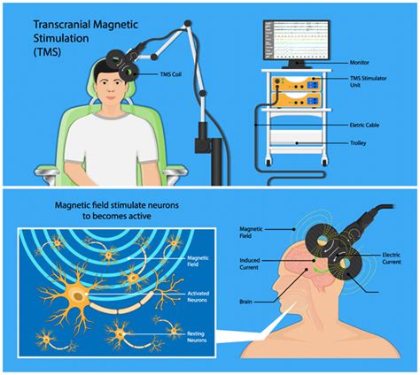 TMS Clinic | Transcranial Magnetic Stimulation Therapy