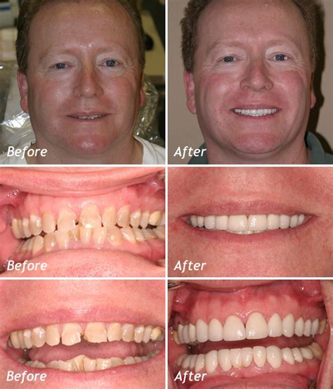 Before and after | Cosmetic dentistry veneers, Perfect teeth, Dental implants