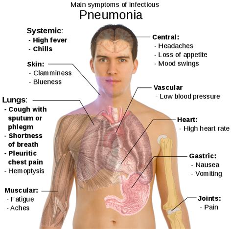 Pneumonia – Symptoms, Causes, Treatment