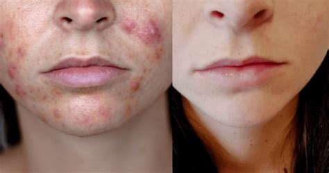 Hormonal acne treatment: Clear skin in 4 months