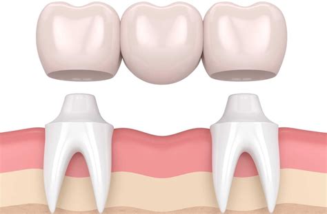 What is a Dental Bridge?
