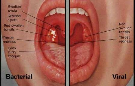 Bacterial vs Viral Sore Throat | Treatment for sore throat, Throat infection, Strep throat