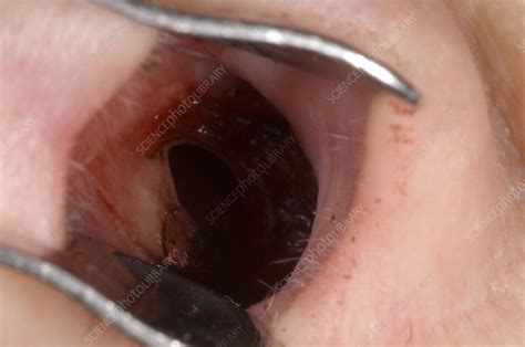 Perforated nasal septum - Stock Image - M330/1534 - Science Photo Library