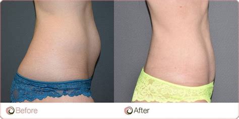 Female Tummy Liposuction - Browse Before & After Results