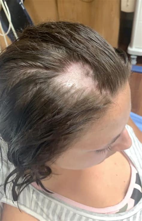 Woman says hair fell out 'in clumps' after using conditioner from Walmart