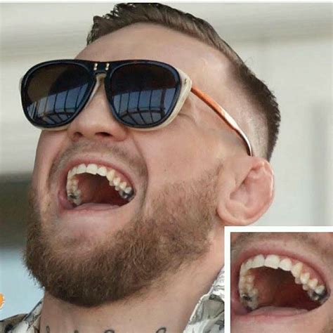 Conor McGregor knows that silver fillings last twice as long than tooth colored fillings ...