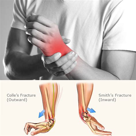 What is a Smith’s fracture? - Tanya Coats Occupational Therapy